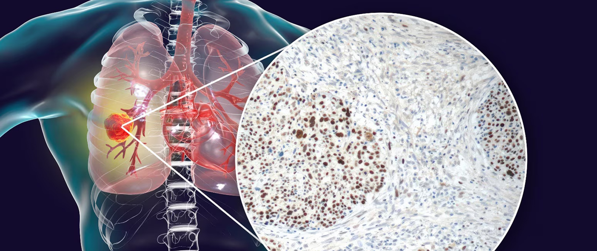 6 Non-Smoking Causes of Lung Cancer: A Comprehensive Overview